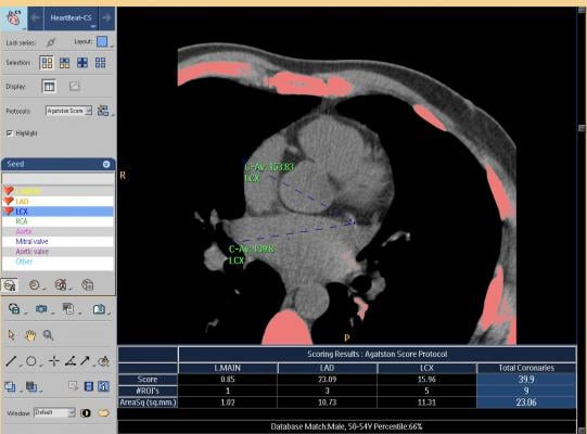 heart CT scans, coronary calcium score, disease risk, Johns Hopkins study