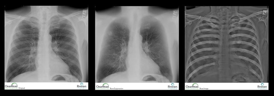 Riverain Technologies, ClearRead Bone Suppression, ClearRead Confirm, UCHealth, University of Colorado, chest X-ray, lung cancer detection