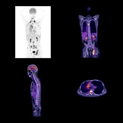 Blue Earth Diagnostics Announcing Results of FALCON PET/CT Trial at ASTRO 2017