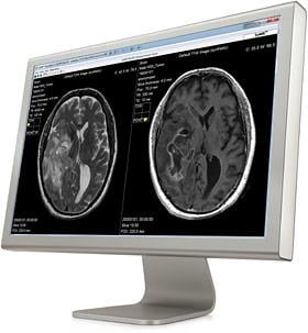 SyntheticMR, MRI software, SyMRI, REMyDI, automatic myelin volume measurement, RSNA 2016