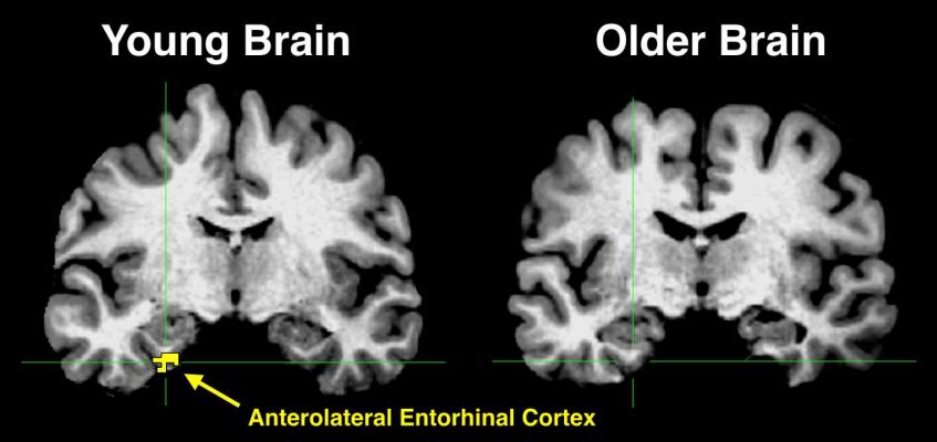 The yellow in the anterolateral entorhinal cortex of the young brain indicates significant activity, something that is absent in the older brain.
