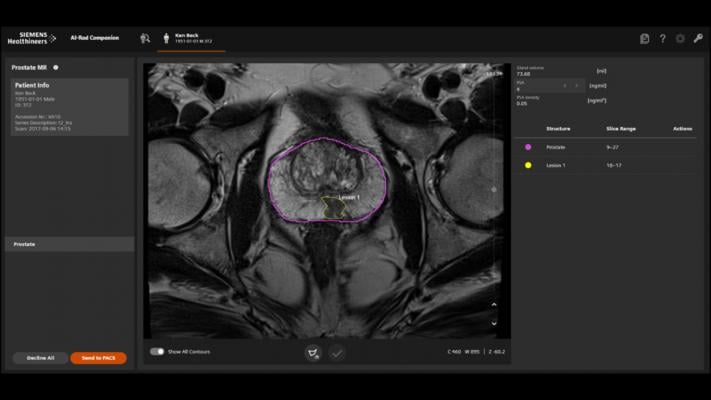 AI-Rad Companion Prostate MR for Biopsy Support segments prostate for targeted biopsy under MRI and ultrasound fusion imaging