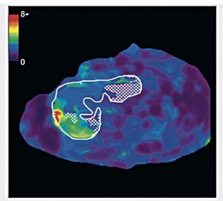 UC San Diego study, liver fibrosis, MRE, magnetic resonance elastography