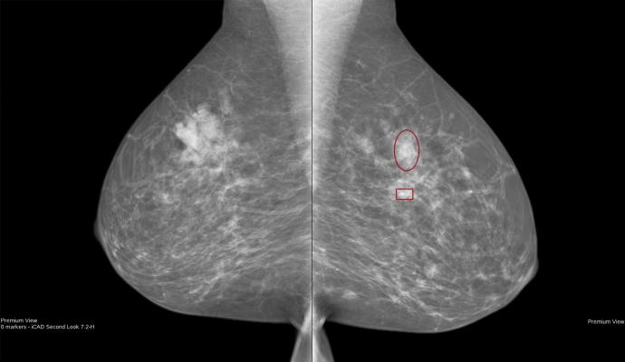 American Society of Breast Surgeons Issues Risk-based Screening Mammography Guidelines