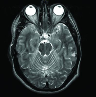 MRI, gadolinium contrast, Parkinsonism, nervous system disorder, Blayne Welk, Western University