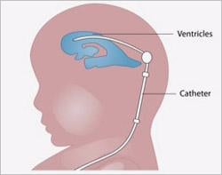 spina bifida, surgery, MRI scans of fetuses brains, NIH, MOMS study
