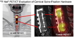 SNM 2011 Image of the Year: 18F NaF PET/CT Evaluation of Cervical Spine Fixation Hardware