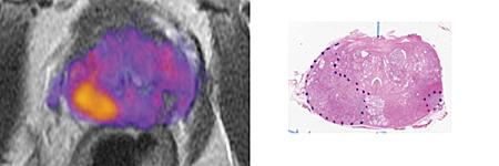 prostate cancer, MRI, RSI, restriction spectrum imaging, tumor grade, UC San Diego study