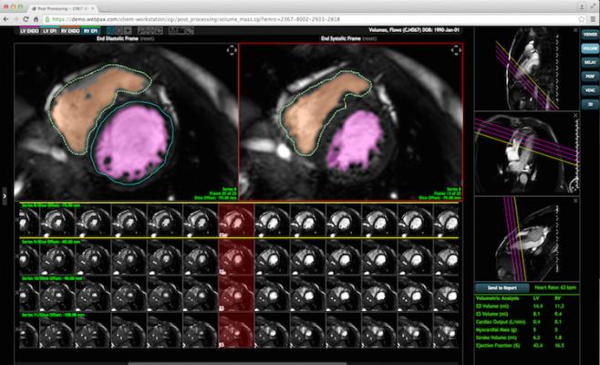 Heart Imaging Technologies, Precession, cardiac magnetic resonance, software