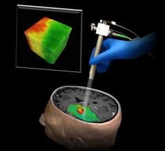 brain tumors, optical coherence tomography, OCT, Johns Hopkins