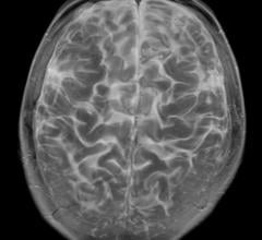 MRI May Predict Neurological Outcomes for Cardiac Arrest Survivors