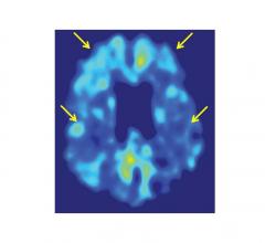 New PET Image Analysis Technique Tracks Amyloid Changes With Greater Power