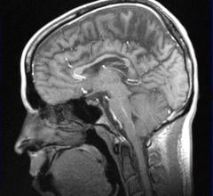 Gadolinium based contrast agents (GBCAs) used in MRI causes gadolinium retention in the brain, posing possible patient safety issues. Jeff Zagoudis