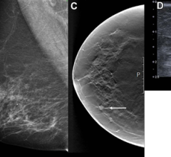 Images in a 68-year-old woman with a screen-detected ductal carcinoma in situ with an artificial intelligence (AI) score of 10 on the screening mammograms.