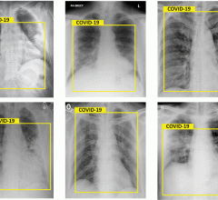 Results of chest X-Rays, detected as Covid-19.