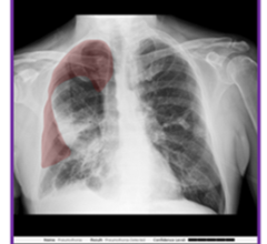 As part of the latest Critical Care Suite 2.1 offering, new on-device AI helps detect and localize pneumothorax (PTX) – providing immediate notification and overlay for the presence or absence of PTX