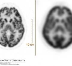 A 90-second brain acquisition with FDG radiotracer — comparison of digital (Vereos, left, 1 mm) and conventional (Gemini TF, 4 mm) images.