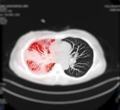 The Centers for Medicare & Medicaid Services (CMS) is announcing a national coverage determination (NCD) that expands coverage for lung cancer screening with low dose computed tomography (LDCT) to improve health outcomes for people with lung cancer. 