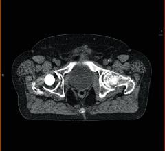 CT Scans Help Predict Patient Survival Following Hip Fractures