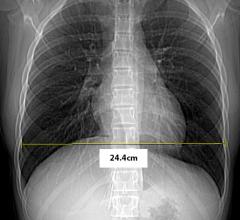 New Image Wisely Radiation Safety Case Available: Optimizing Radiation Use During a Difficult IVC Filter Retrieval