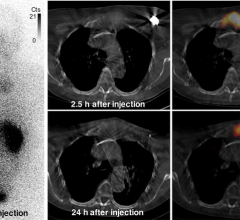 Images of uptake in bone metastasis in patient 2. Anterior whole-body (left) and SPECT/CT (right) images show uptake of 131I-GMIB-anti-HER2-VHH1 at level of large lytic bone metastasis, with soft-tissue component at sternal bone both at 2.5 h and at 24 h after injection. Small differences in area of uptake are explained by differences in patient positioning (arms up at 2.5 h and arms down at 24 h, to maximize patient comfort). Cts = counts. Image created by M. Keyaerts, University Hospital of Brussels (UZ B