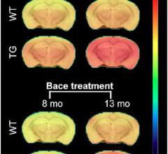 PET Tracer Gauges Effectiveness of Promising Alzheimer's Treatment