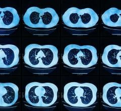 The Moscow Center for Diagnostics and Telemedicine presented clinical research findings during ECR 2021 highlighting that full integration of AI into radiology workflow during the pandemic increased radiologists' productivity