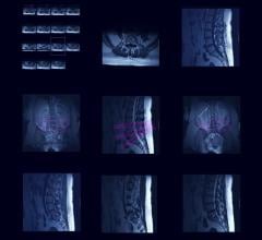 Asterias MRI Data Shows AST-OPC1 Cells Prevent Cavitation in Severe Spinal Cord Injury Patients