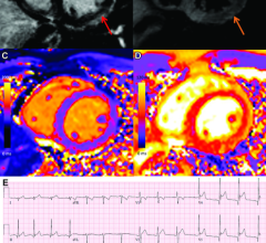 COVID-19 vaccine associated myocarditis. Short-axis 1.5T MRI images and ECG findings of a 19-year-old man with myopericarditis who presented with chest pain 3 days following the second dose of an mRNA COVID-19 vaccine (mRNA-1273). Cardiac MRI performed 2 days after symptom onset demonstrates mid wall to subepicardial late gadolinium enhancement (LGE) at the basal to mid inferior lateral wall with adjacent pericardial enhancement (A, red arrow), corresponding hyperintensity on T2-weighted imaging (B, orange 