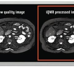 FDA Clears Medic Vision's iQMR MRI Image Enhancement Technology