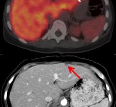 Axial fused 89Zr-5B1 antibody PET/CT image demonstrates focus of uptake in the liver (arrow). Focus of uptake correlates with increased liver metastasis seen on diagnostic CT (red arrow) performed 2 weeks prior