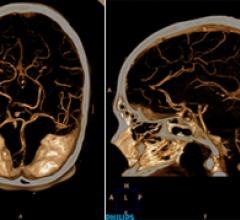 A low-dose neuro CTA using a Philips Ingenuity CT.