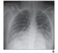 16-year-old girl with coronavirus disease (COVID-19) and known history of tuberous sclerosis who presented with acute hypoxic respiratory distress. Reverse transcription–polymerase chain reaction testing confirmed diagnosis of severe acute respiratory syndrome coronavirus 2 (SARS-CoV-2).
