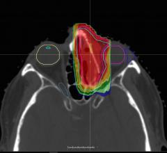 Mevion Receives 510(k) Clearance for Hyperscan Pencil Beam Scanning Proton Therapy