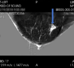 QTI’s Breast Acoustic CT Scans for mass detection reported results from its second blinded multi-reader multi-case study