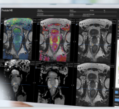 The FDA clearance, Quantib’s 6th to date, marks the first time a comprehensive AI prostate solution will be available to radiologists in the United States