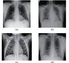 Samples from the dataset used in this study. (a) X-ray with PA view of a patient with COVID-19; (b) X-ray with AP view of a patient with COVID-19; (c) X-ray of a healthy patient from Dataset A; (d) X-ray of a healthy patient from Dataset B.