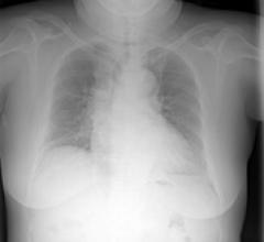 Application Helps Physicians Identify More Lung Nodules in Chest X-Rays