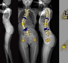 EOS imaging Receives FDA Approval for spineEOS, its online 3D Planning Solution for Spine Surgery