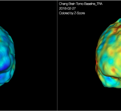 FDA Clears CereMetrix’s Neuroimaging Analytics and Clinical Workflow Platform