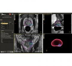 Synergy Radiology Associates Employs UroNav Fusion Biopsy System for Better Prostate Cancer Diagnosis