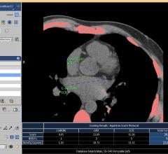 heart CT scans, coronary calcium score, disease risk, Johns Hopkins study