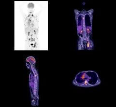 Blue Earth Diagnostics Announcing Results of FALCON PET/CT Trial at ASTRO 2017