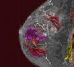 3T MRI Detects "Early" Breast Cancer Not Seen On Mammography, Ultrasound