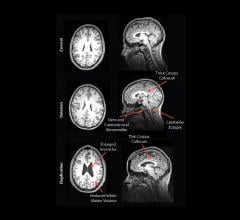 MRI Reveals Striking Brain Differences in People with Genetic Autism