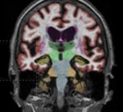 Gadolinium based contrast dye in brain MRI 