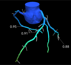 An example of a HeartFlow FFR-CT image showing the blood flow through what looked like a significant blockage on CT angiography alone, actually was not flow-limiting based on computational fluid dynamics. Use of the technology was supposed to reduce the number of diagnostic catheterizations in the FORECAST trial, but the costs of FFR-CT were not offset enough to show cost savings.