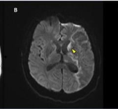 Figure 1. Stroke seen in a 41-year-old male patient with COVID-19 infection.