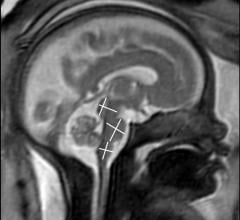 Figure 1. MRI of fetal brain development.
