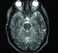 MRI, gadolinium contrast, Parkinsonism, nervous system disorder, Blayne Welk, Western University